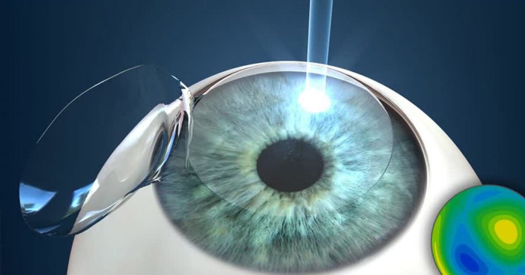 飛秒雷射Lasik